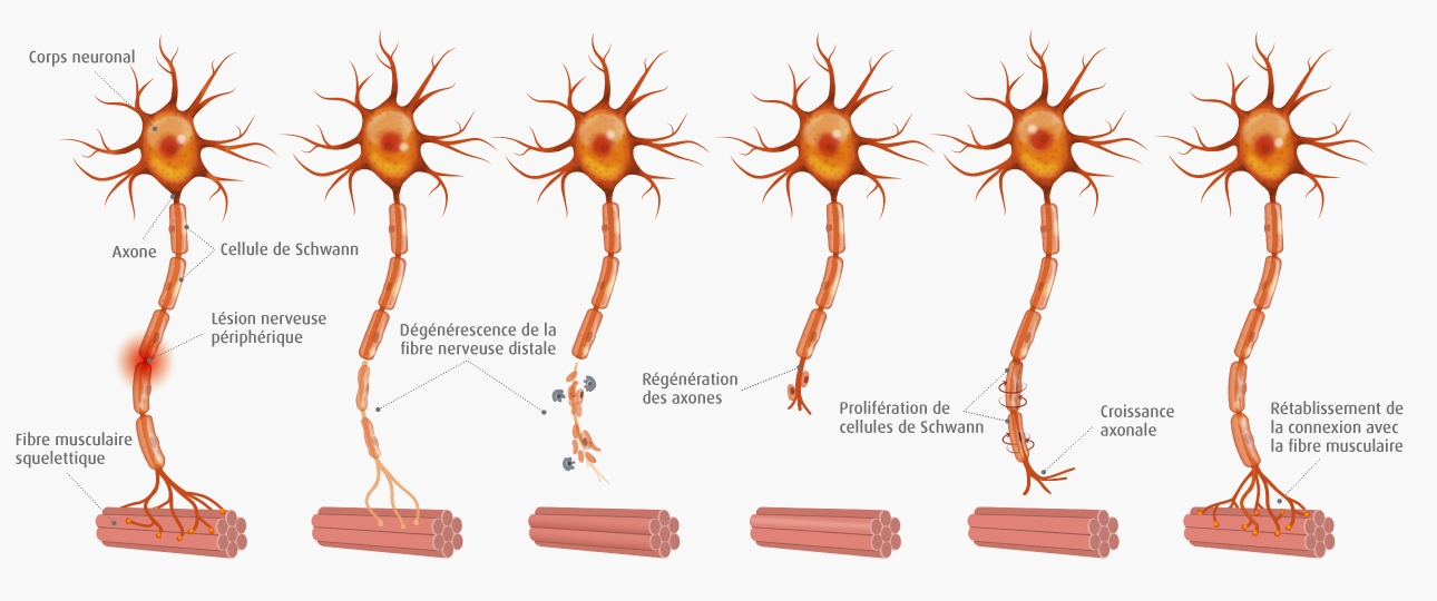 Récupération neuropathie