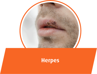 Herpes