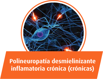Polineuropatia desmielinizante