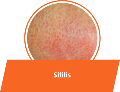 Sífilis